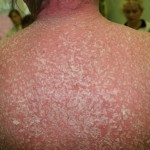 psoriat_eritroderm_183.jpg